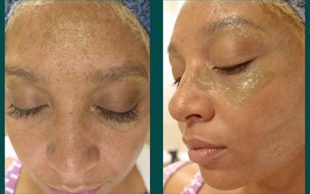 Résultats spectaculaires du peeling aux algues : avant/après en photos pour une peau transformée